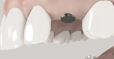 Implantation in zwei Schritten